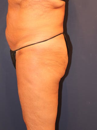 Emsculpt Neo Before & After Gallery - Patient 537763 - Image 4