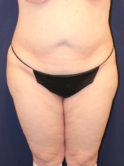 Liposuction Before & After Gallery - Patient 223687 - Image 1