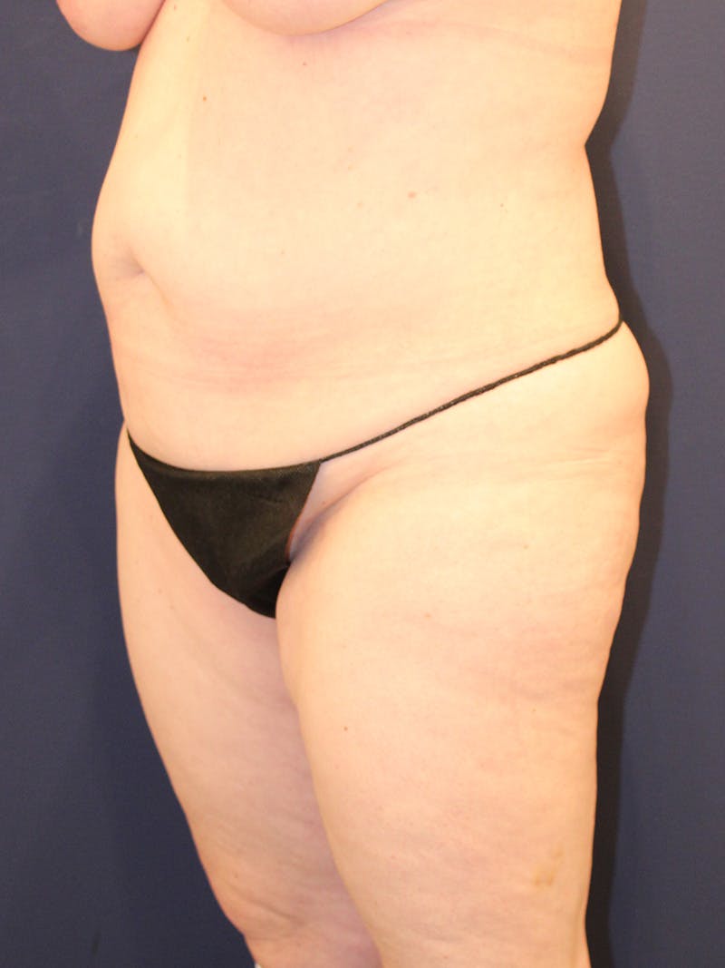 Liposuction Before & After Gallery - Patient 223687 - Image 3