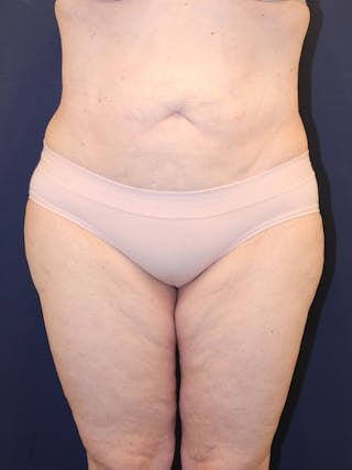 Liposuction Before & After Gallery - Patient 223687 - Image 2
