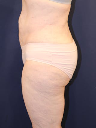 Liposuction Before & After Gallery - Patient 223687 - Image 6
