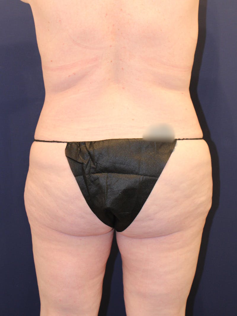 Liposuction Before & After Gallery - Patient 223687 - Image 7