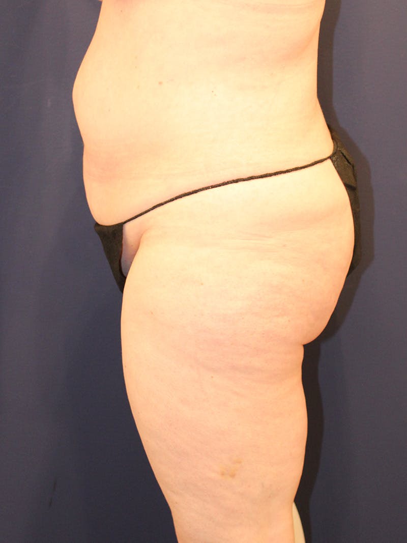 Liposuction Before & After Gallery - Patient 223687 - Image 5