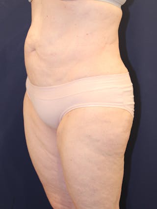 Liposuction Before & After Gallery - Patient 223687 - Image 4