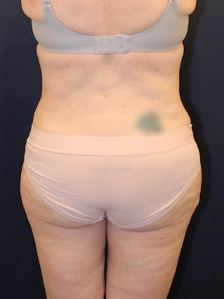 Liposuction Before & After Gallery - Patient 223687 - Image 8