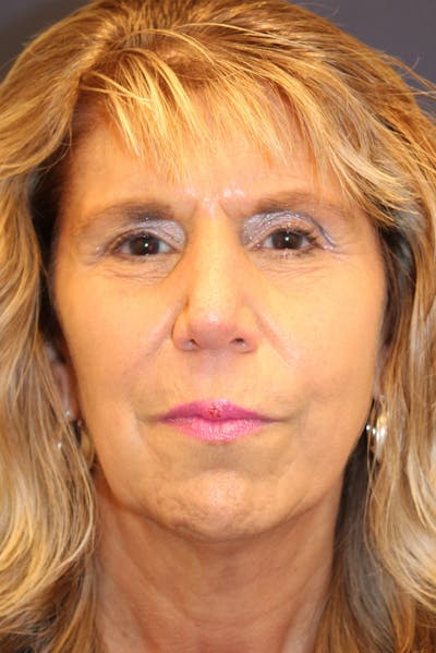 Sofwave Before & After Gallery - Patient 193242 - Image 2