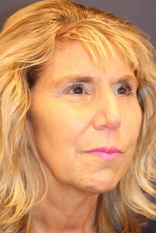 Sofwave Before & After Gallery - Patient 193242 - Image 8