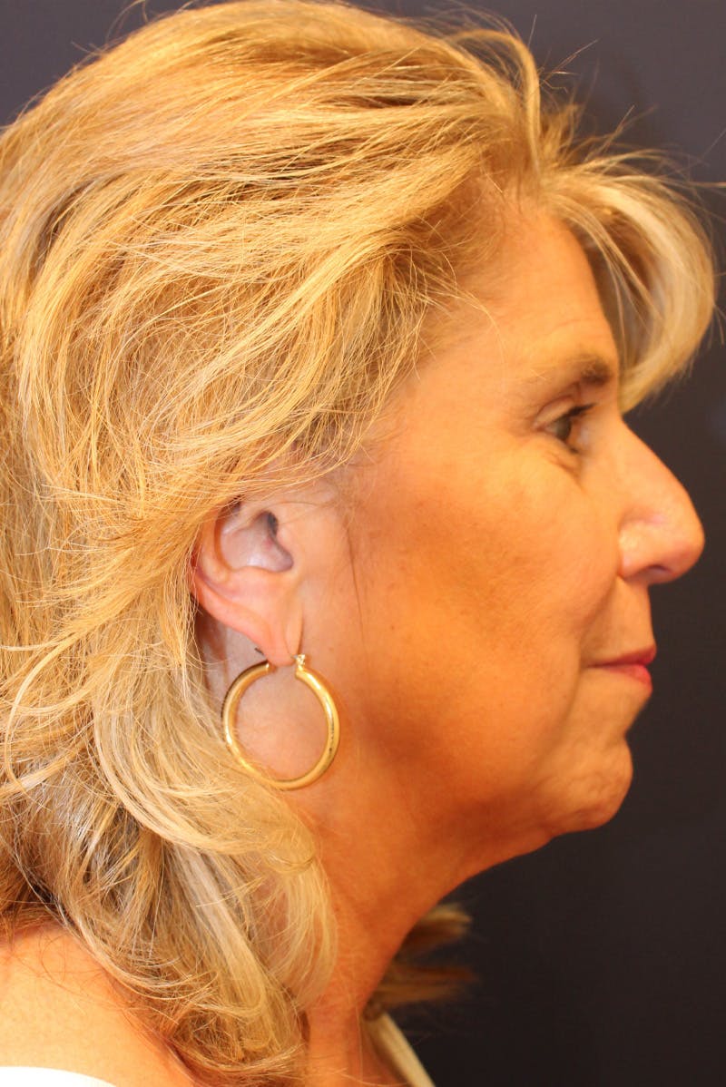 Sofwave Before & After Gallery - Patient 193242 - Image 9