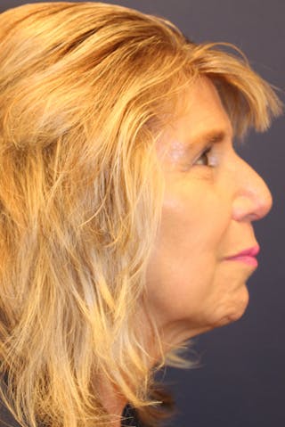 Sofwave Before & After Gallery - Patient 193242 - Image 10