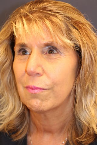 Sofwave Before & After Gallery - Patient 193242 - Image 4