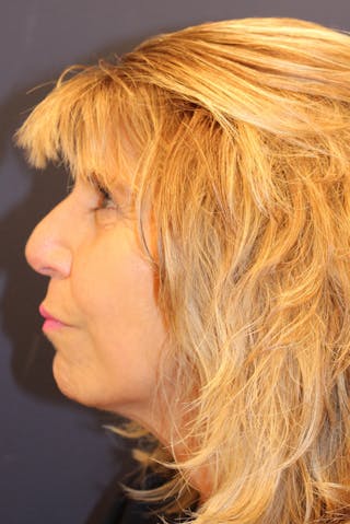 Sofwave Before & After Gallery - Patient 193242 - Image 6