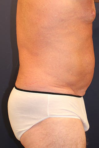 Liposuction Before & After Gallery - Patient 253360 - Image 6