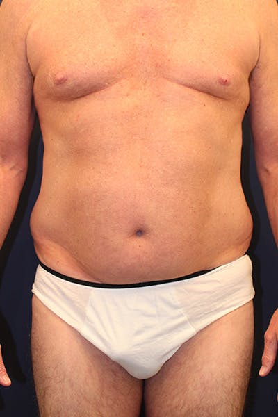 Liposuction Before & After Gallery - Patient 253360 - Image 1