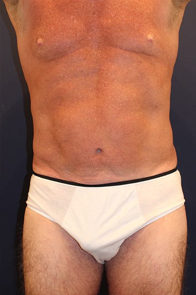 Liposuction Before & After Gallery - Patient 253360 - Image 2