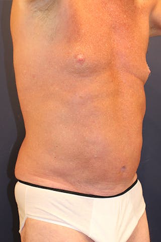 Liposuction Before & After Gallery - Patient 253360 - Image 4
