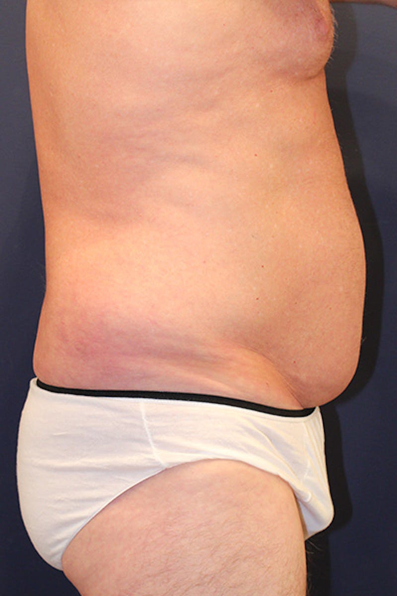 Liposuction Before & After Gallery - Patient 253360 - Image 5