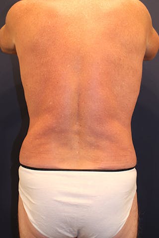 Liposuction Before & After Gallery - Patient 253360 - Image 8