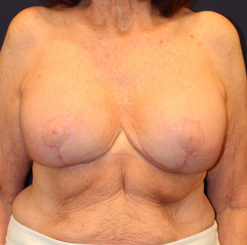 Breast Implant Revision Before & After Gallery - Patient 281120 - Image 2