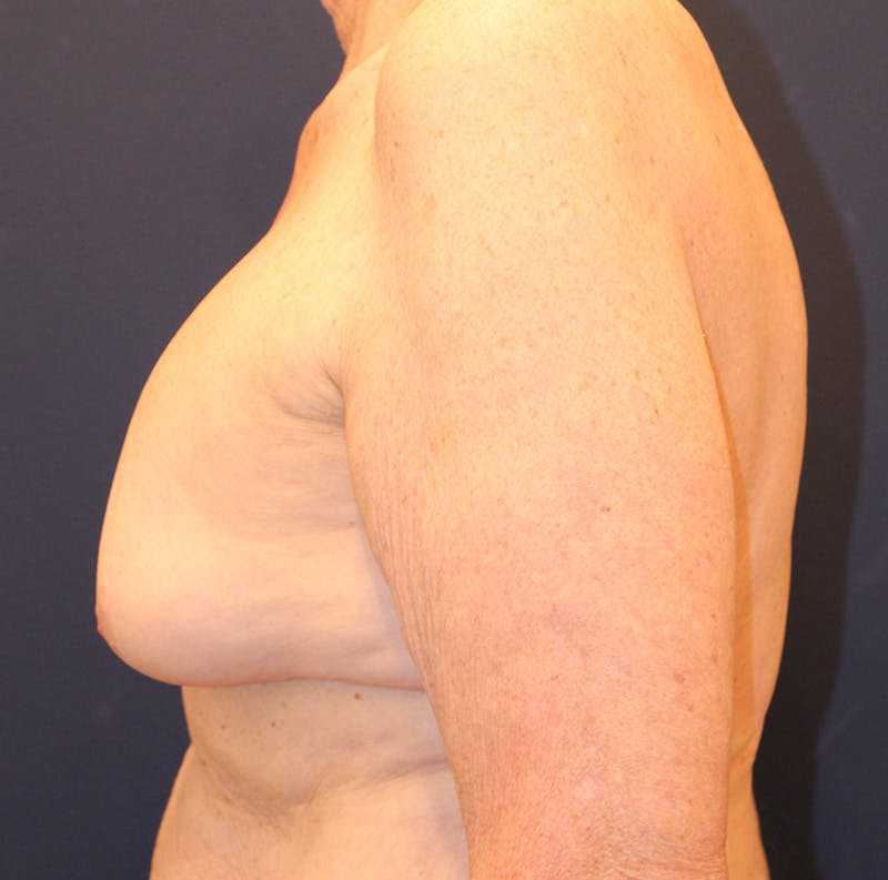 Breast Implant Revision Before & After Gallery - Patient 281120 - Image 5