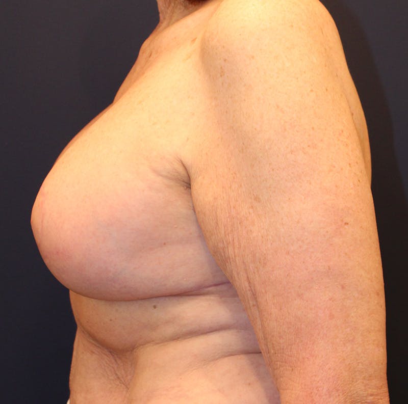 Breast Implant Revision Before & After Gallery - Patient 281120 - Image 6