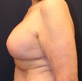 Breast Lift Before & After Gallery - Patient 632920 - Image 6