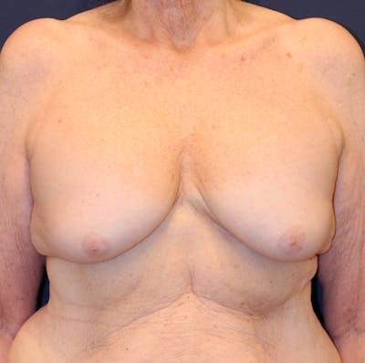 Breast Lift Before & After Gallery - Patient 632920 - Image 1