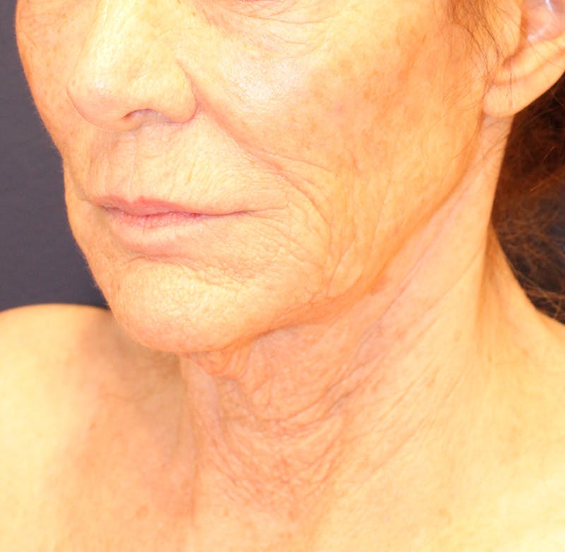 Sofwave Before & After Gallery - Patient 294313 - Image 3