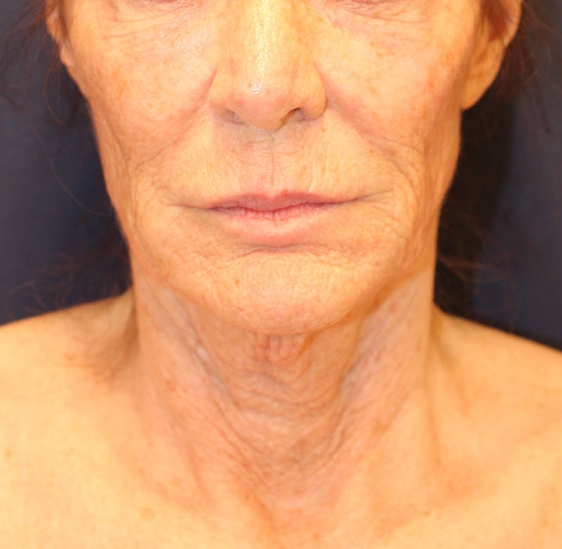 Sofwave Before & After Gallery - Patient 294313 - Image 1