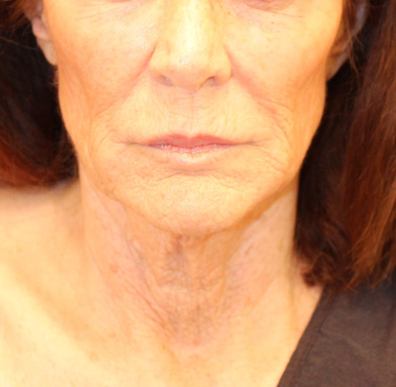 Sofwave Before & After Gallery - Patient 294313 - Image 2