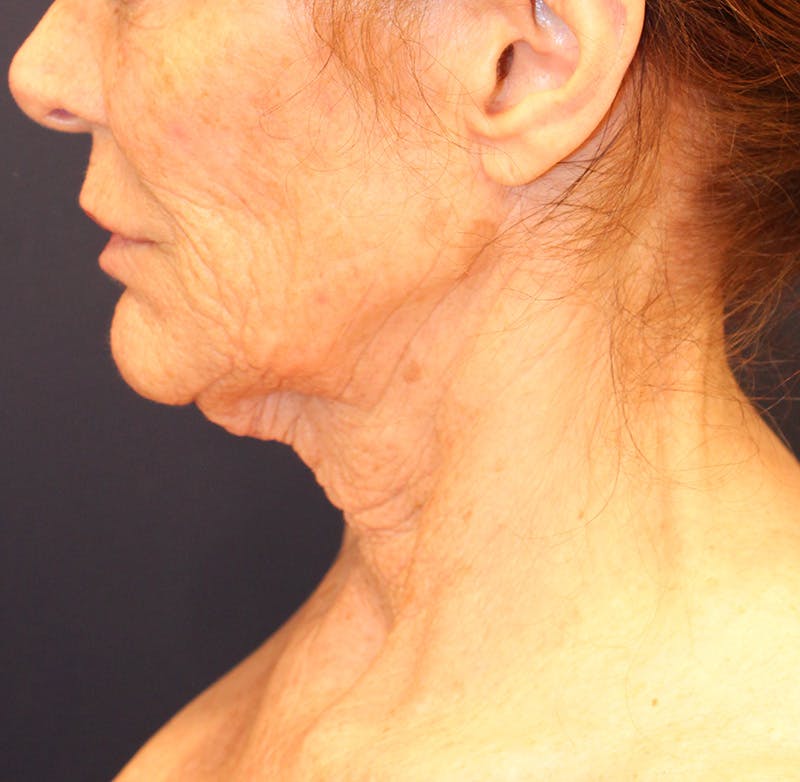 Sofwave Before & After Gallery - Patient 294313 - Image 5