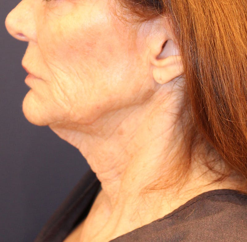 Sofwave Before & After Gallery - Patient 294313 - Image 6