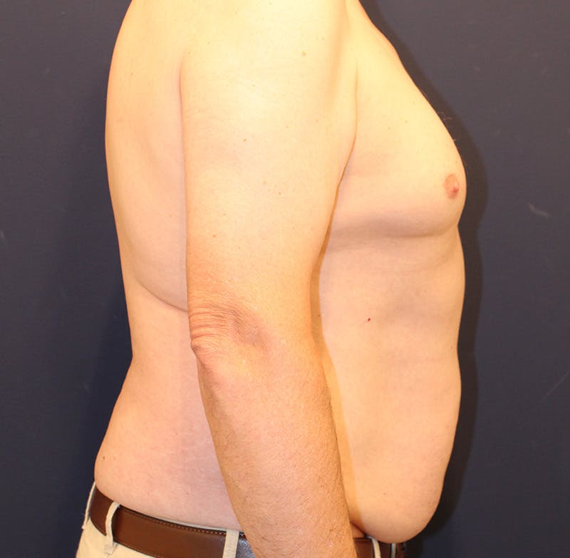 Emsculpt Neo Before & After Gallery - Patient 758352 - Image 5