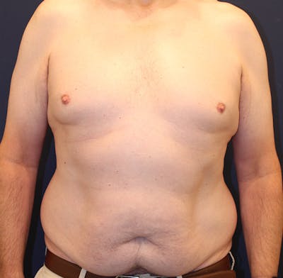 Emsculpt Neo Before & After Gallery - Patient 758352 - Image 1