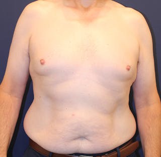 Emsculpt Neo Before & After Gallery - Patient 758352 - Image 2