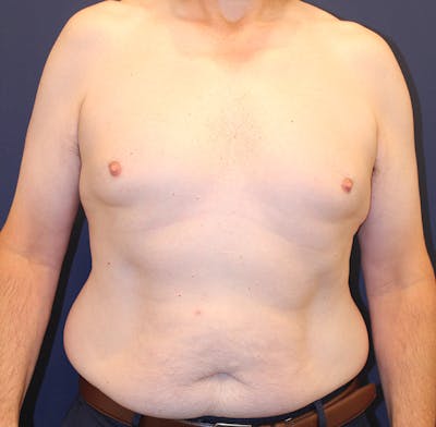 Emsculpt Neo Before & After Gallery - Patient 758352 - Image 2