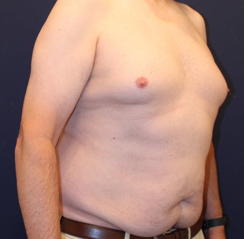 Emsculpt Neo Before & After Gallery - Patient 758352 - Image 3