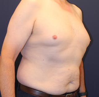 Emsculpt Neo Before & After Gallery - Patient 758352 - Image 4