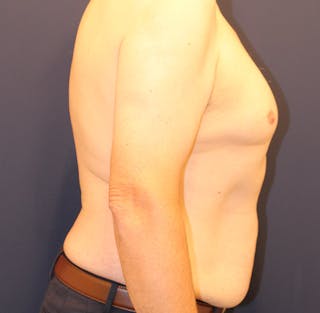 Emsculpt Neo Before & After Gallery - Patient 758352 - Image 6