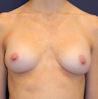 Breast Augmentation Before & After Gallery - Patient 185159 - Image 2
