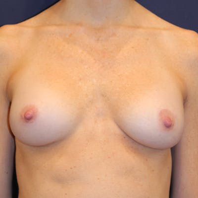 Breast Augmentation Before & After Gallery - Patient 185159 - Image 2