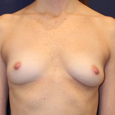 Breast Augmentation Before & After Gallery - Patient 185159 - Image 1