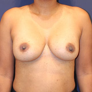 Breast Augmentation Before & After Gallery - Patient 152361 - Image 2