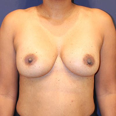 Breast Augmentation Before & After Gallery - Patient 152361 - Image 2