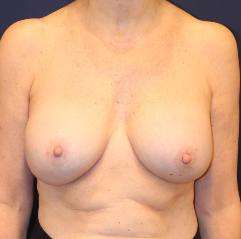 Breast Implant Revision Before & After Gallery - Patient 401331 - Image 2