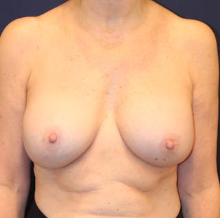 Breast Implant Revision Before & After Gallery - Patient 401331 - Image 2