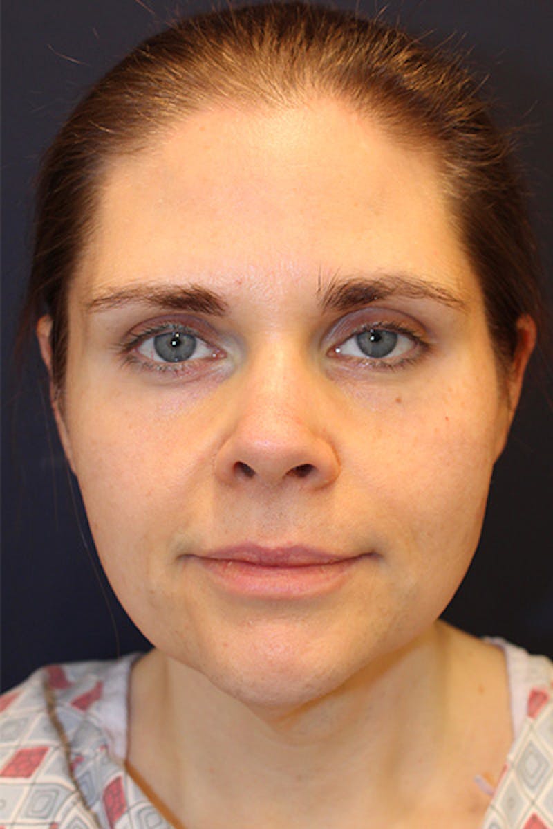 Necklift Before & After Gallery - Patient 175120 - Image 1