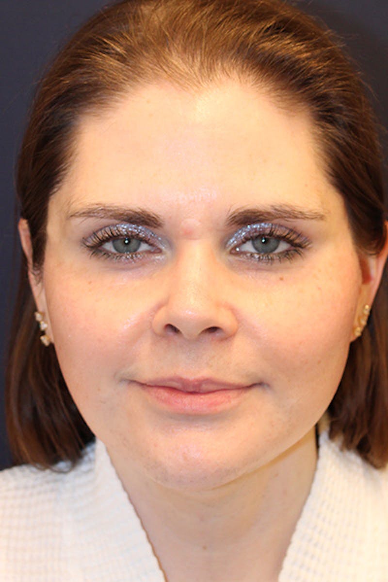 Necklift Before & After Gallery - Patient 175120 - Image 2