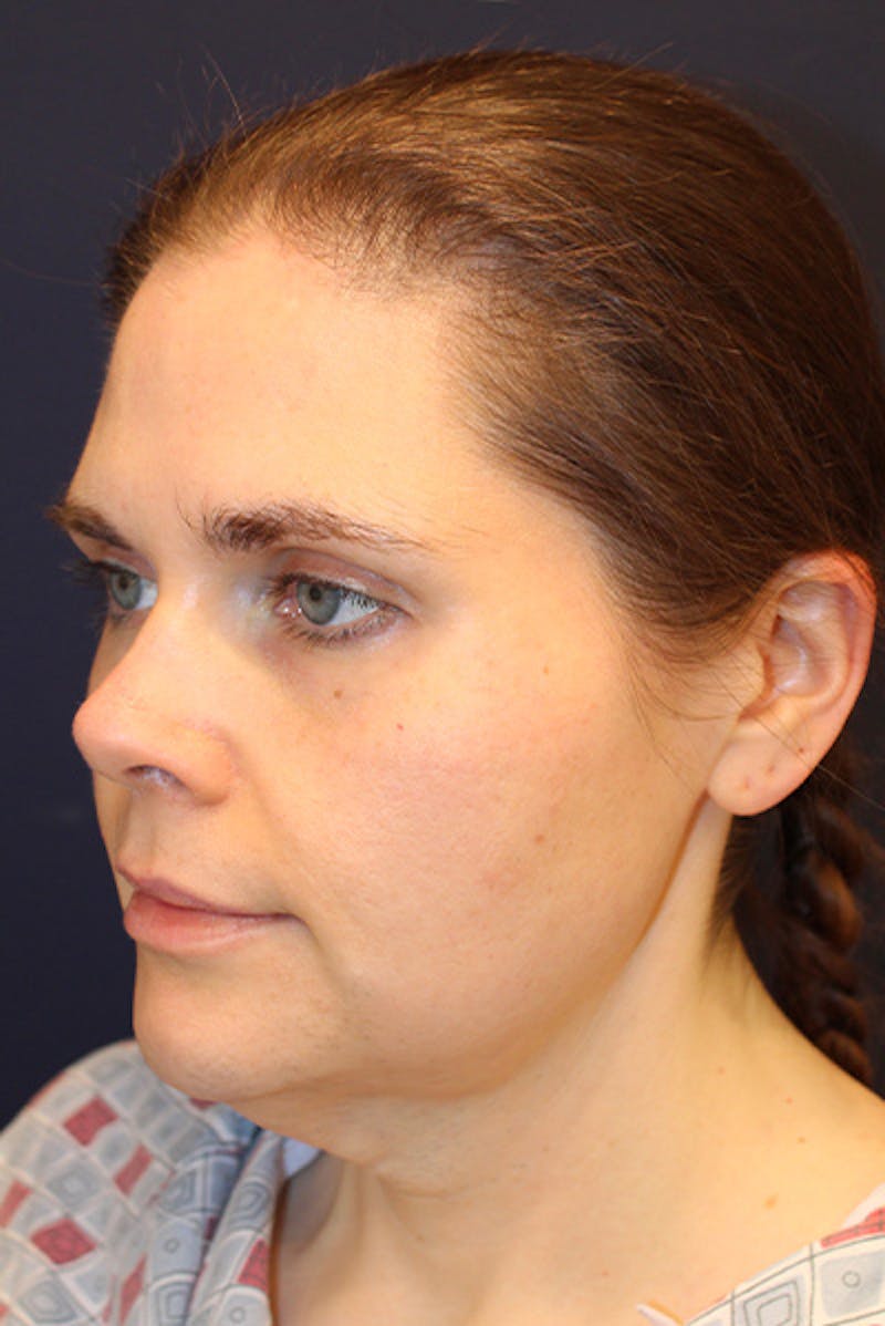 Necklift Before & After Gallery - Patient 175120 - Image 3