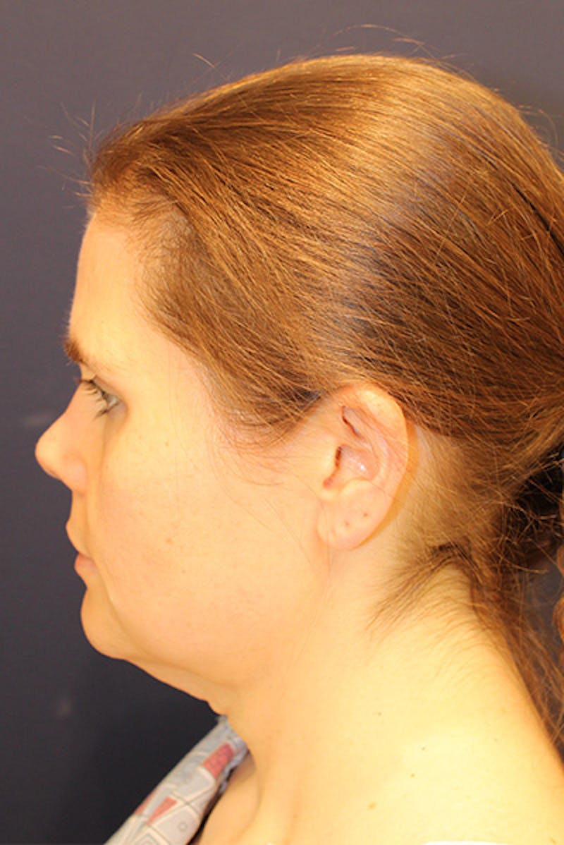 Necklift Before & After Gallery - Patient 175120 - Image 5