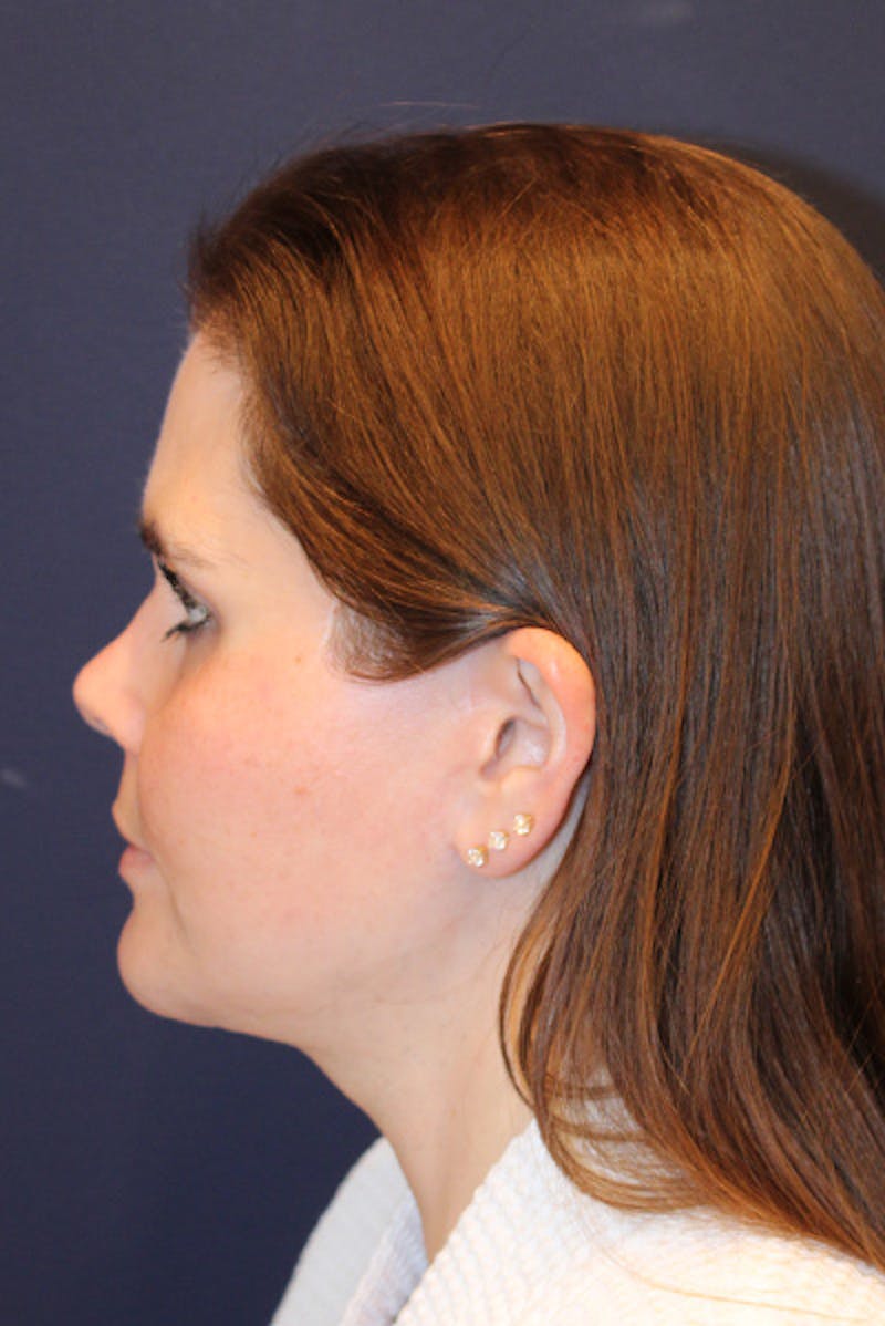 Necklift Before & After Gallery - Patient 175120 - Image 6